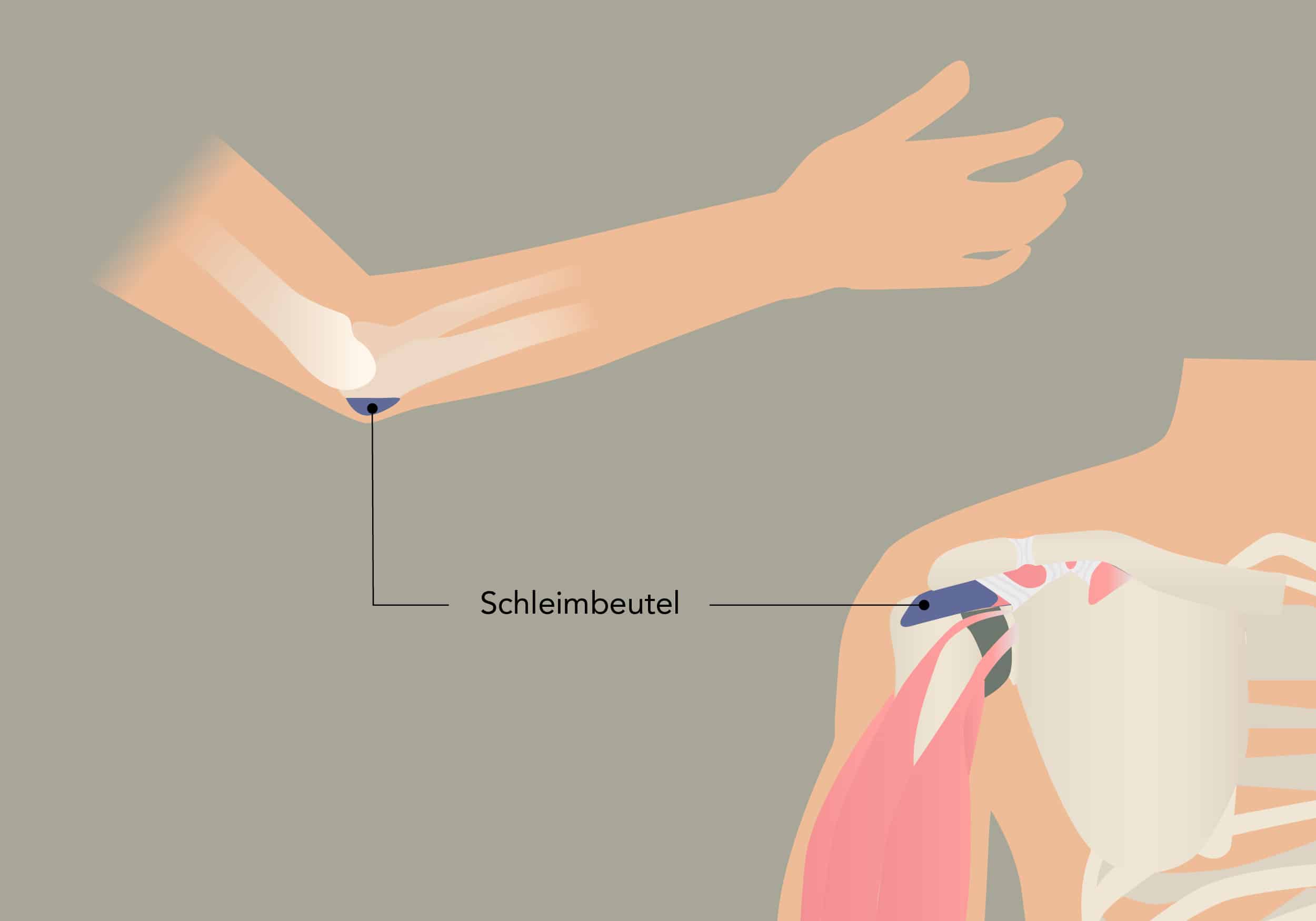 schleimbeutelentzündung schulter homöopathie