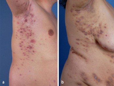 akne inversa homöopathie