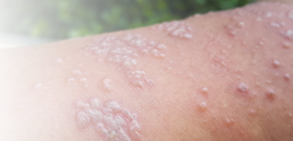 gürtelrose homöopathisch behandeln
